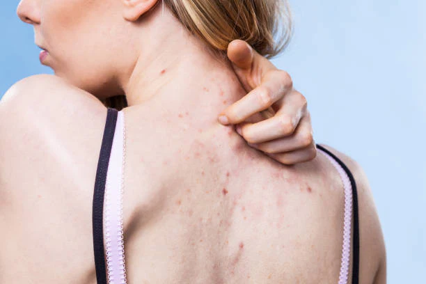 Understanding How Hormones Affect Your Skin
